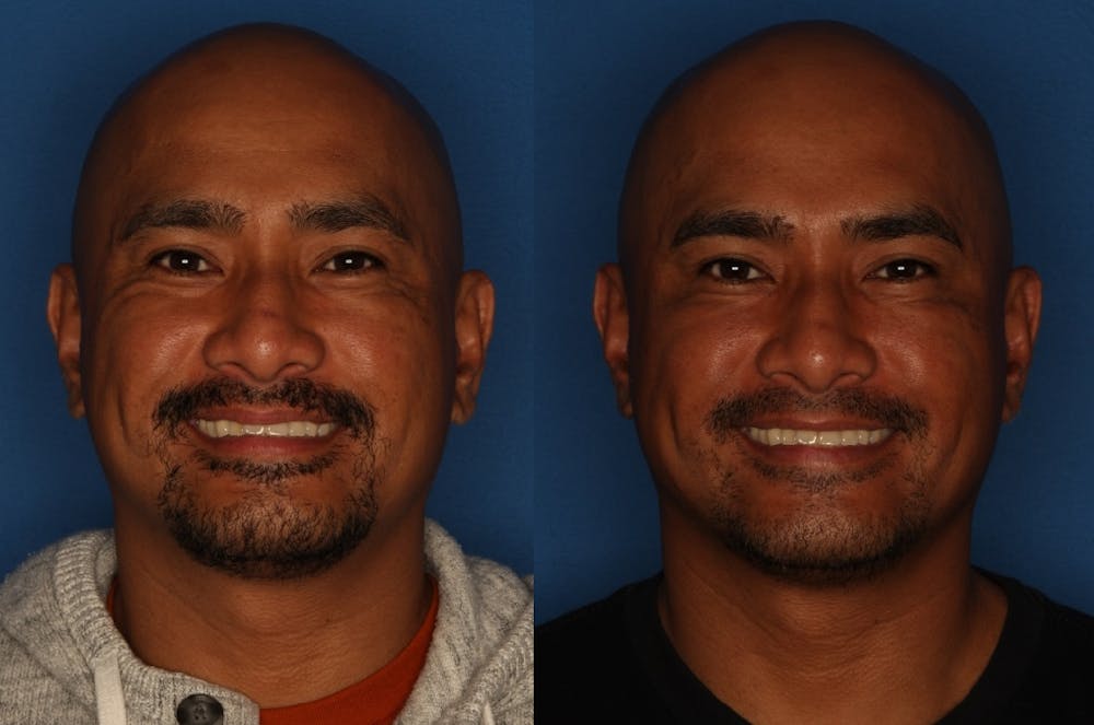 BOTOX Before & After Gallery - Patient 142944786 - Image 4