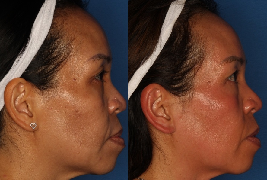 Cosmelan Peel Gallery Before & After Gallery - Patient 133054059 - Image 5