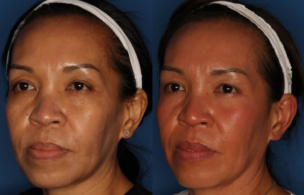 Cosmelan Peel Gallery Before & After Gallery - Patient 133054059 - Image 2