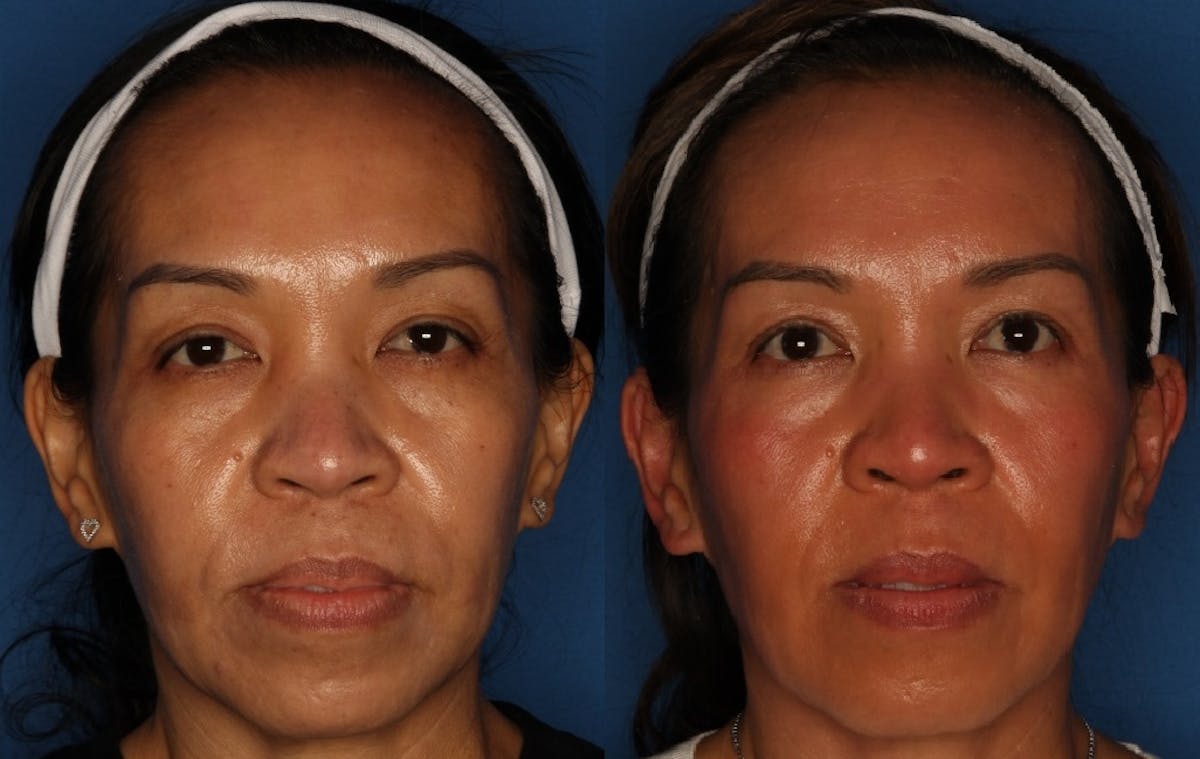 Cosmelan Peel Gallery Before & After Gallery - Patient 133054059 - Image 1