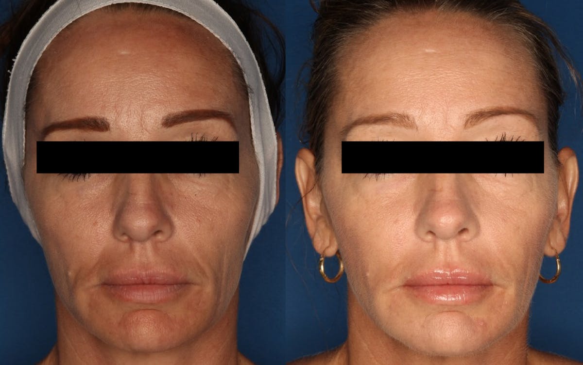 Sculptra Aesthetic Gallery Before & After Gallery - Patient 132771766 - Image 1
