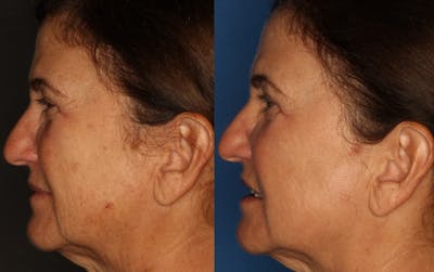 Dermal Fillers Before & After Gallery - Patient 180817 - Image 1