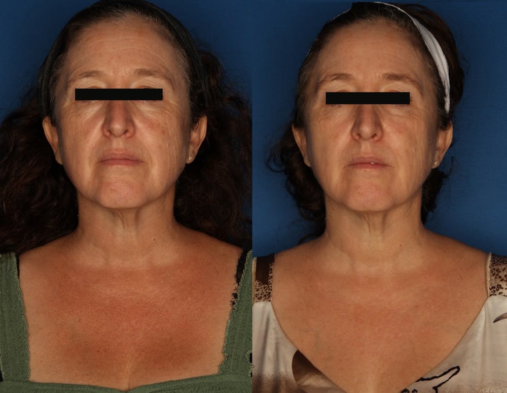 LaserFirm Before & After Gallery - Patient 143398139 - Image 1