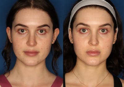 HALO® Laser by Sciton Before & After Gallery - Patient 143398157 - Image 1