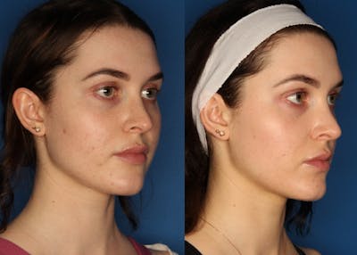 HALO® Laser by Sciton Before & After Gallery - Patient 143398157 - Image 2