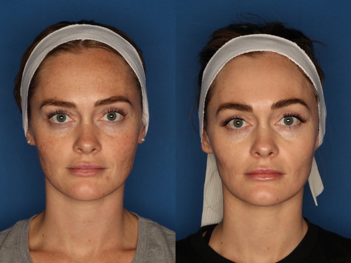 LaserFirm Gallery Before & After Gallery - Patient 143416456 - Image 1