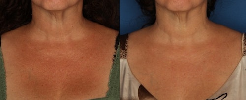 Before and After
