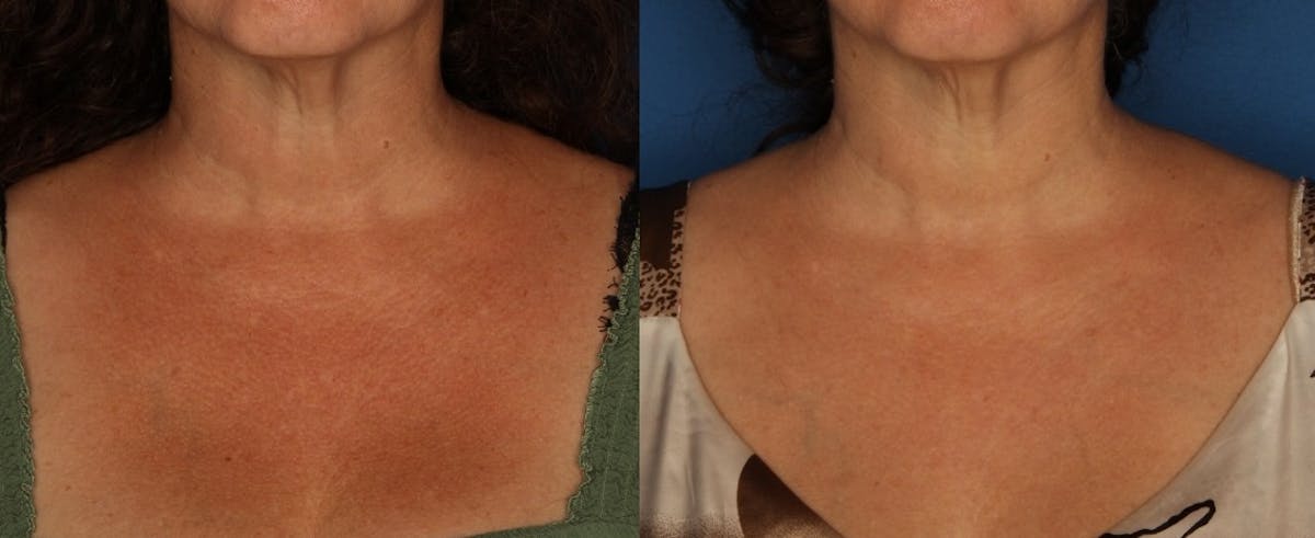 LaserFirm Before & After Gallery - Patient 144612064 - Image 1