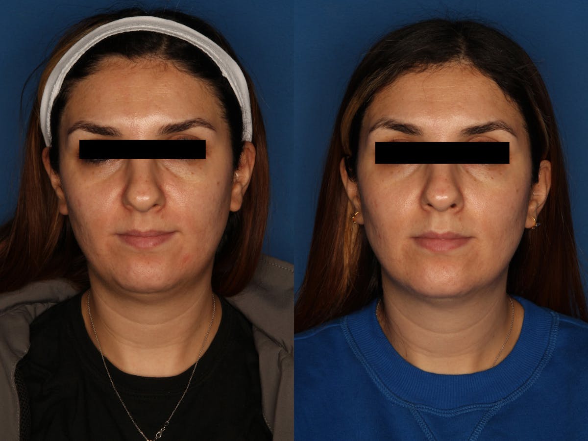 HALO® Laser by Sciton Before & After Gallery - Patient 146082737 - Image 1