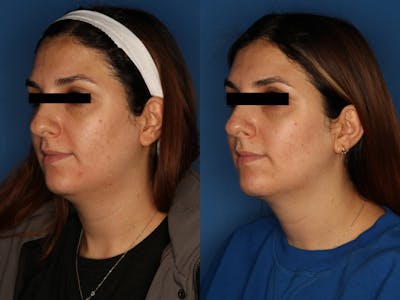 HALO® Laser by Sciton Gallery Before & After Gallery - Patient 146082737 - Image 2