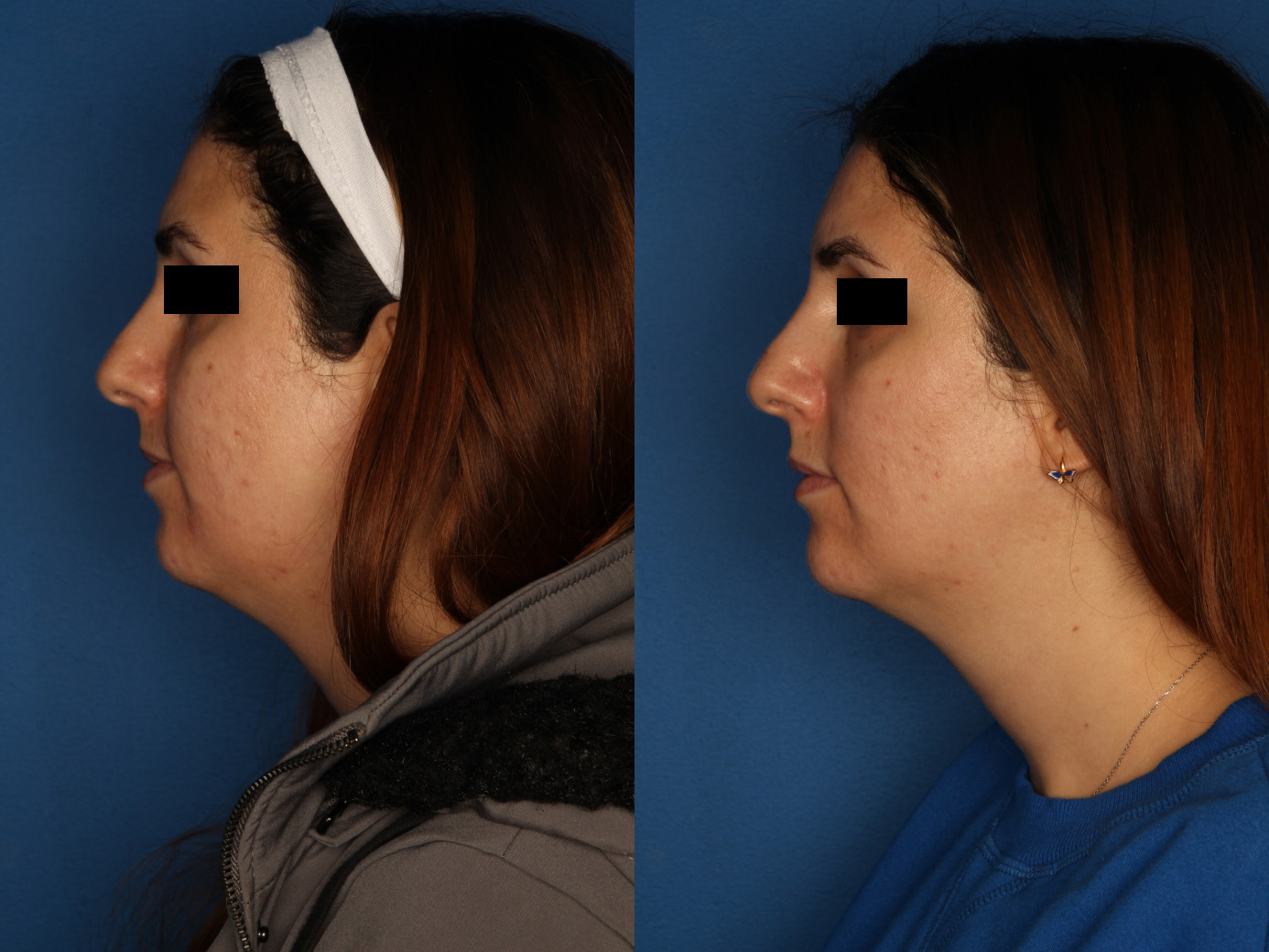 HALO® Laser by Sciton Gallery Before & After Gallery - Patient 146082737 - Image 3