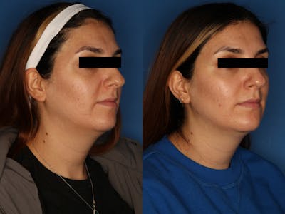 HALO® Laser by Sciton Gallery Before & After Gallery - Patient 146082737 - Image 4
