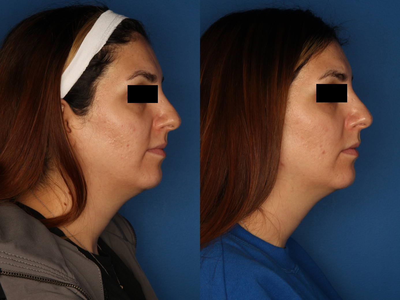 HALO® Laser by Sciton Gallery Before & After Gallery - Patient 146082737 - Image 5