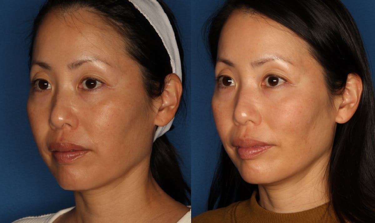 TempSure Envi Before & After Gallery - Patient 146082749 - Image 1