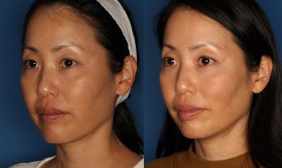 TempSure Envi Before & After Gallery - Patient 146082749 - Image 1