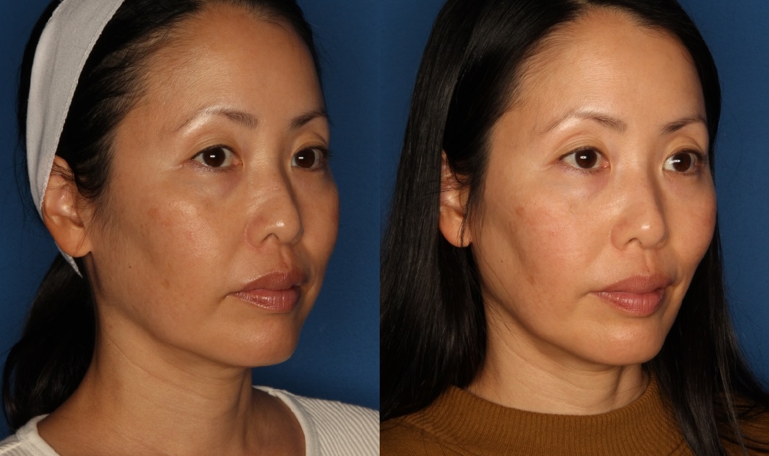 TempSure Envi Before & After Gallery - Patient 146082749 - Image 2