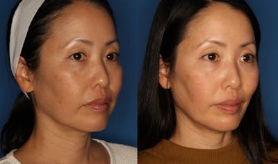 TempSure Envi Before & After Gallery - Patient 146082749 - Image 2