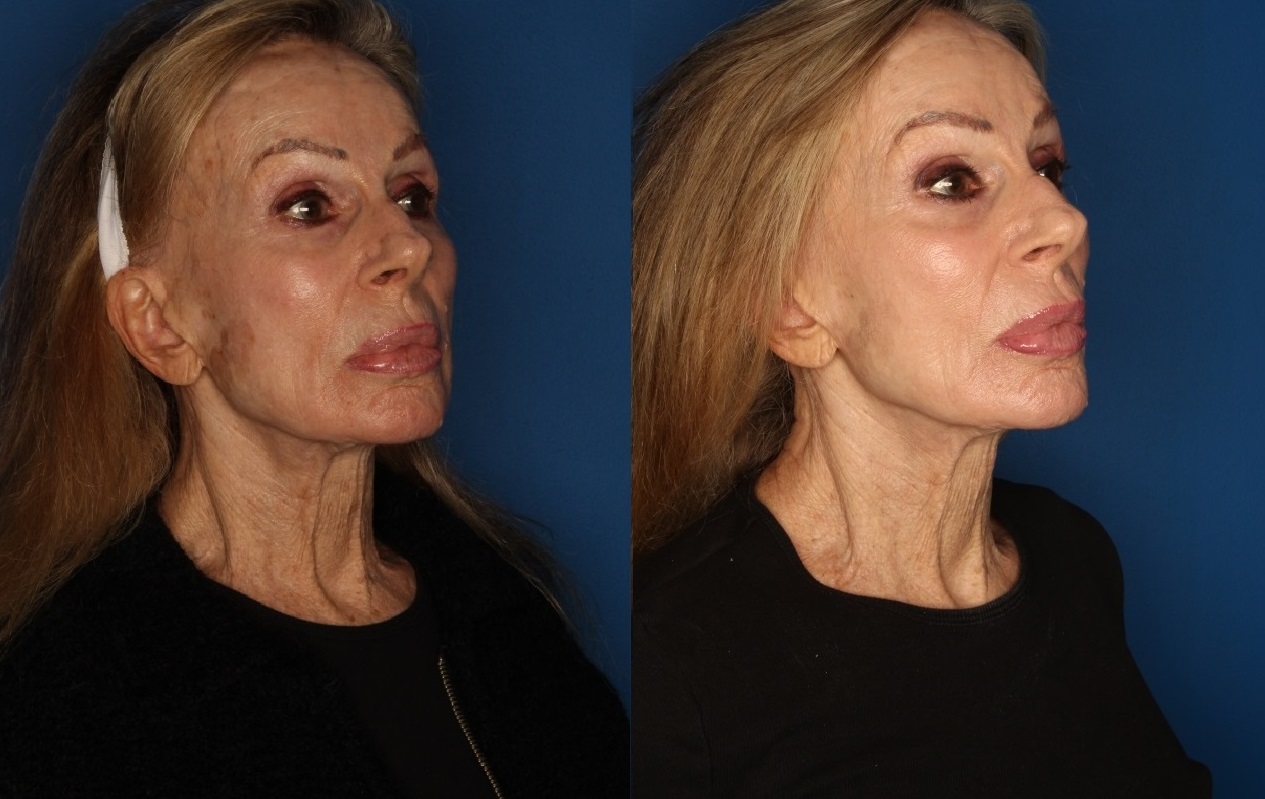 TotalFX Before & After Gallery - Patient 146082755 - Image 1