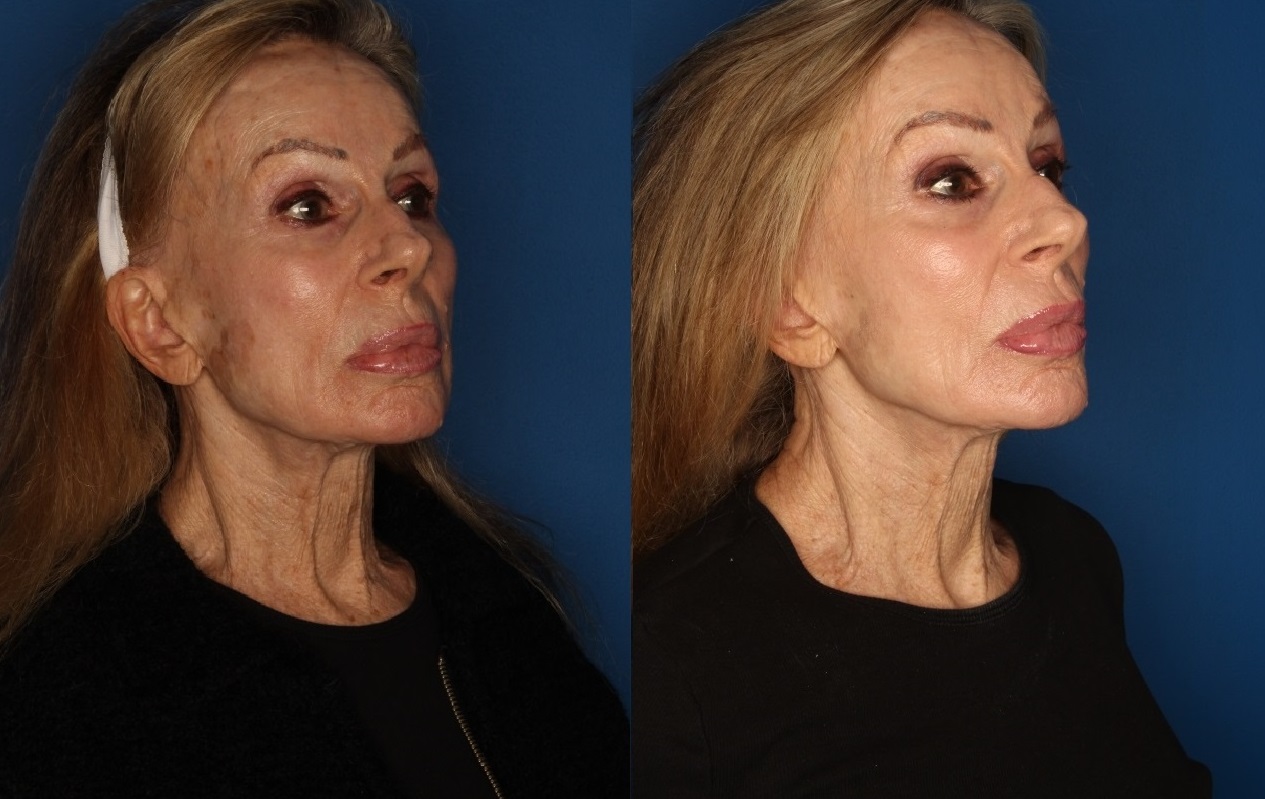 TotalFX Gallery Before & After Gallery - Patient 146082755 - Image 1