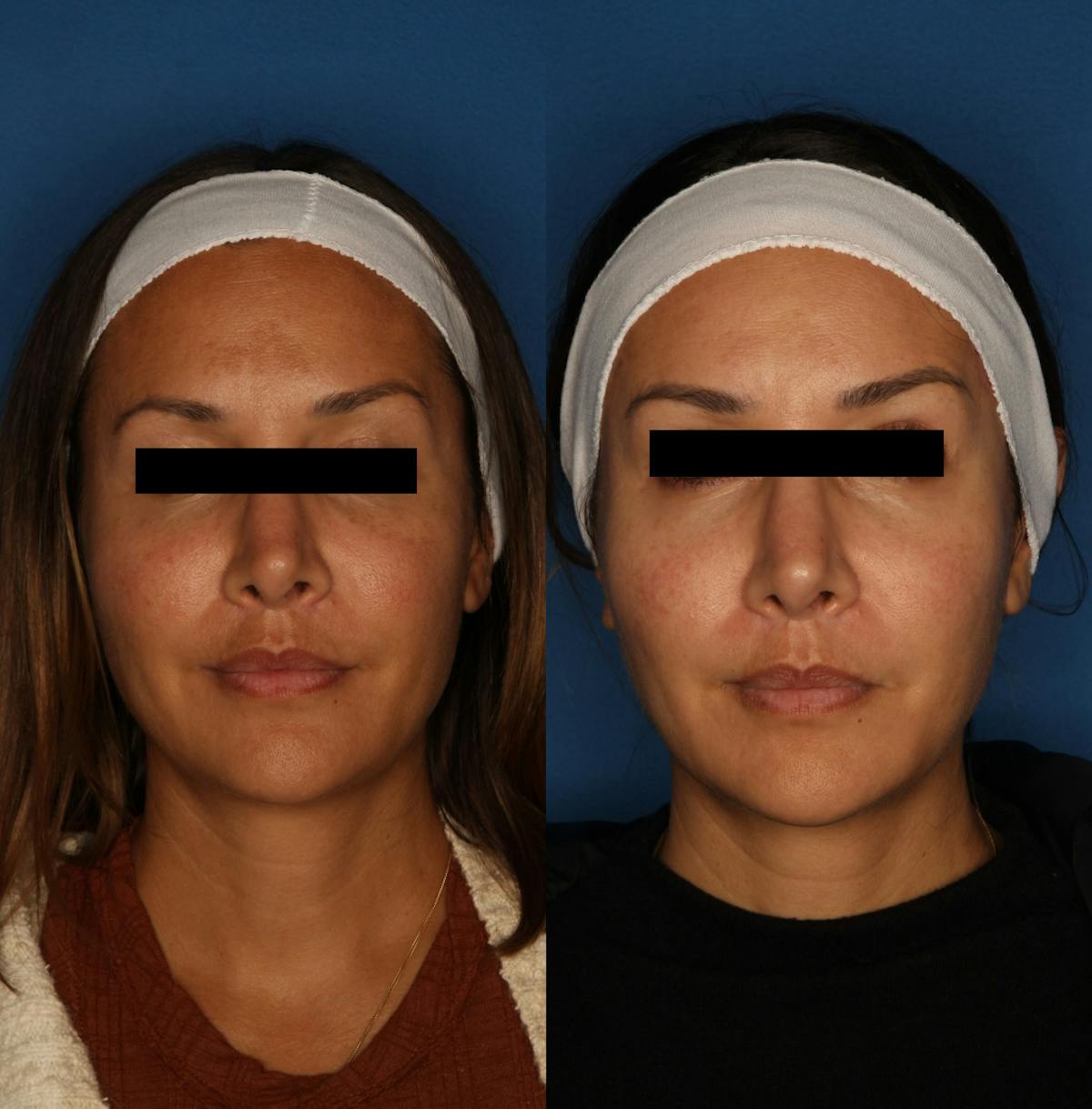 PiQo4™ Laser Before & After Gallery - Patient 146082879 - Image 1