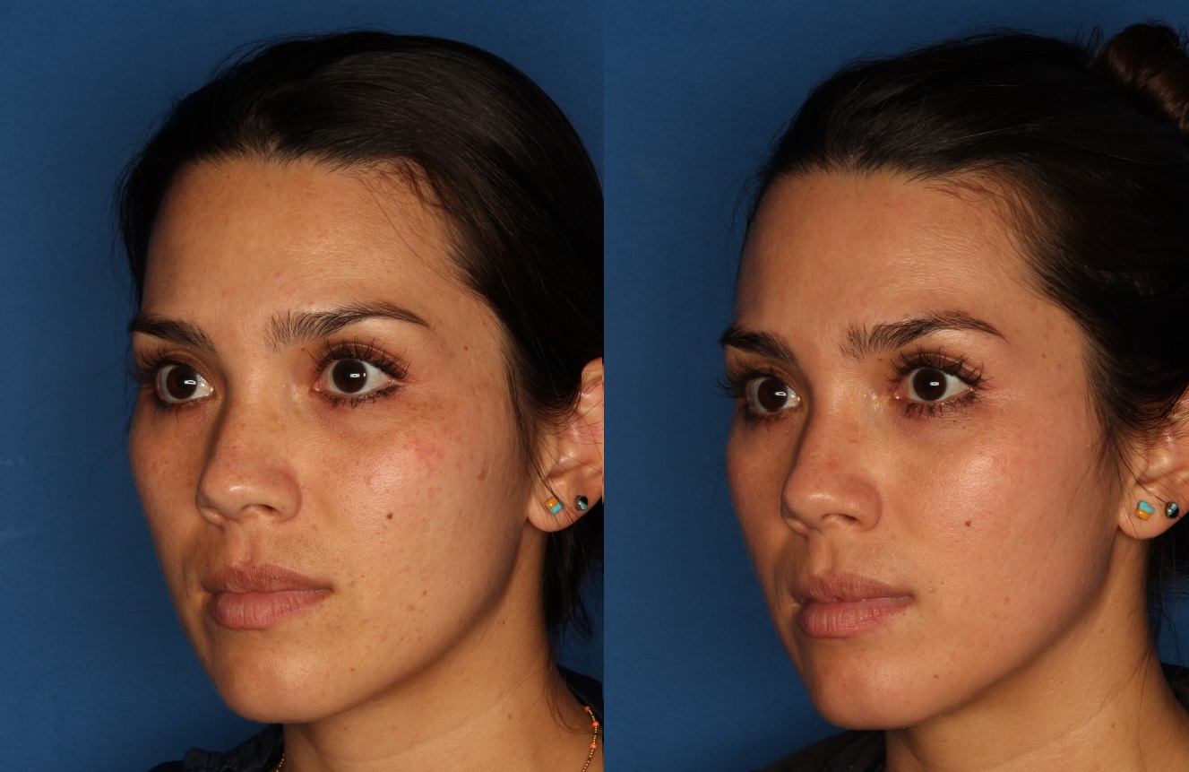 Cosmelan Peel Gallery Before & After Gallery - Patient 146082889 - Image 2