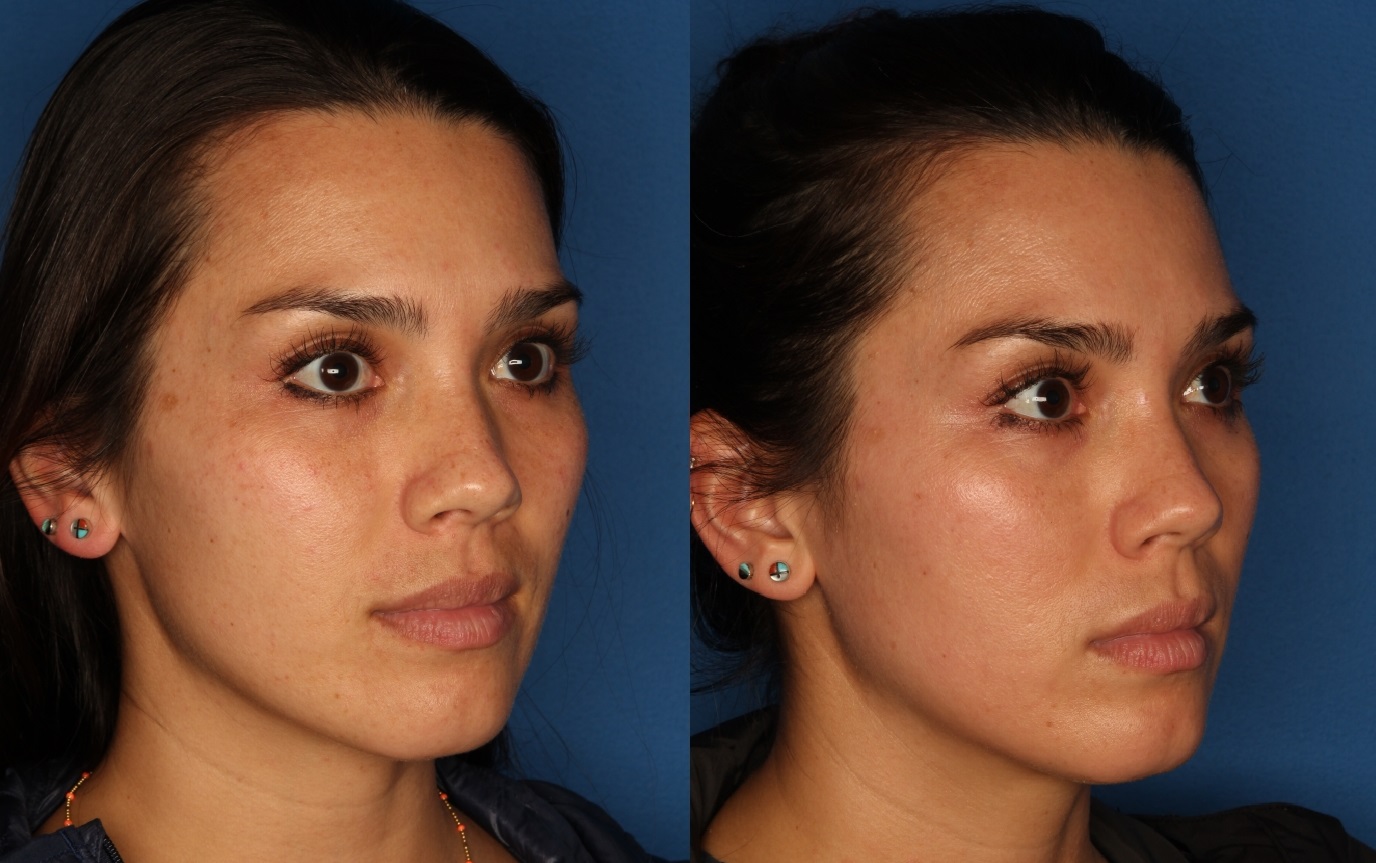 Cosmelan Peel Gallery Before & After Gallery - Patient 146082889 - Image 3