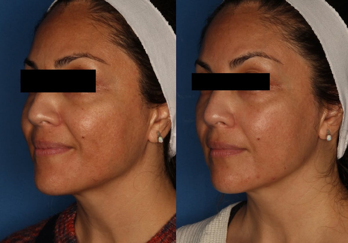 HALO® Laser by Sciton Before & After Gallery - Patient 146621880 - Image 1
