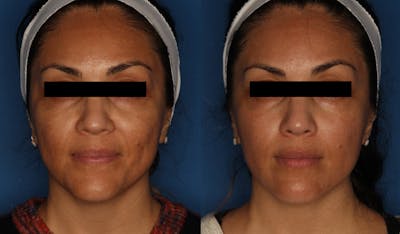 HALO® Laser by Sciton Gallery Before & After Gallery - Patient 146621880 - Image 2