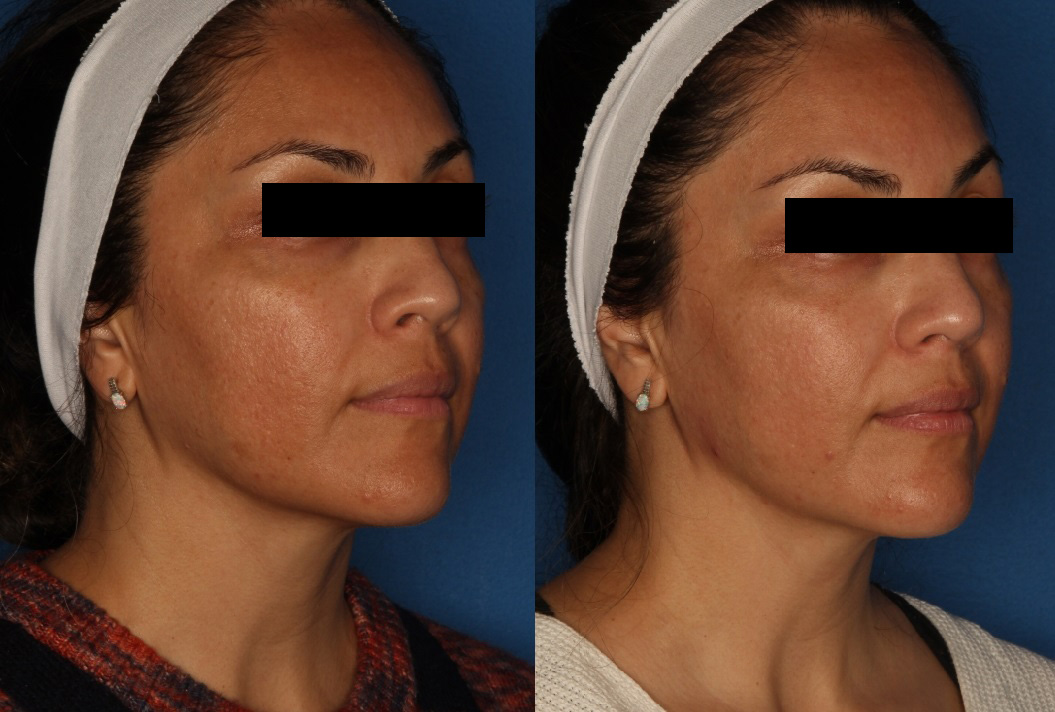 HALO® Laser by Sciton Gallery Before & After Gallery - Patient 146621880 - Image 3