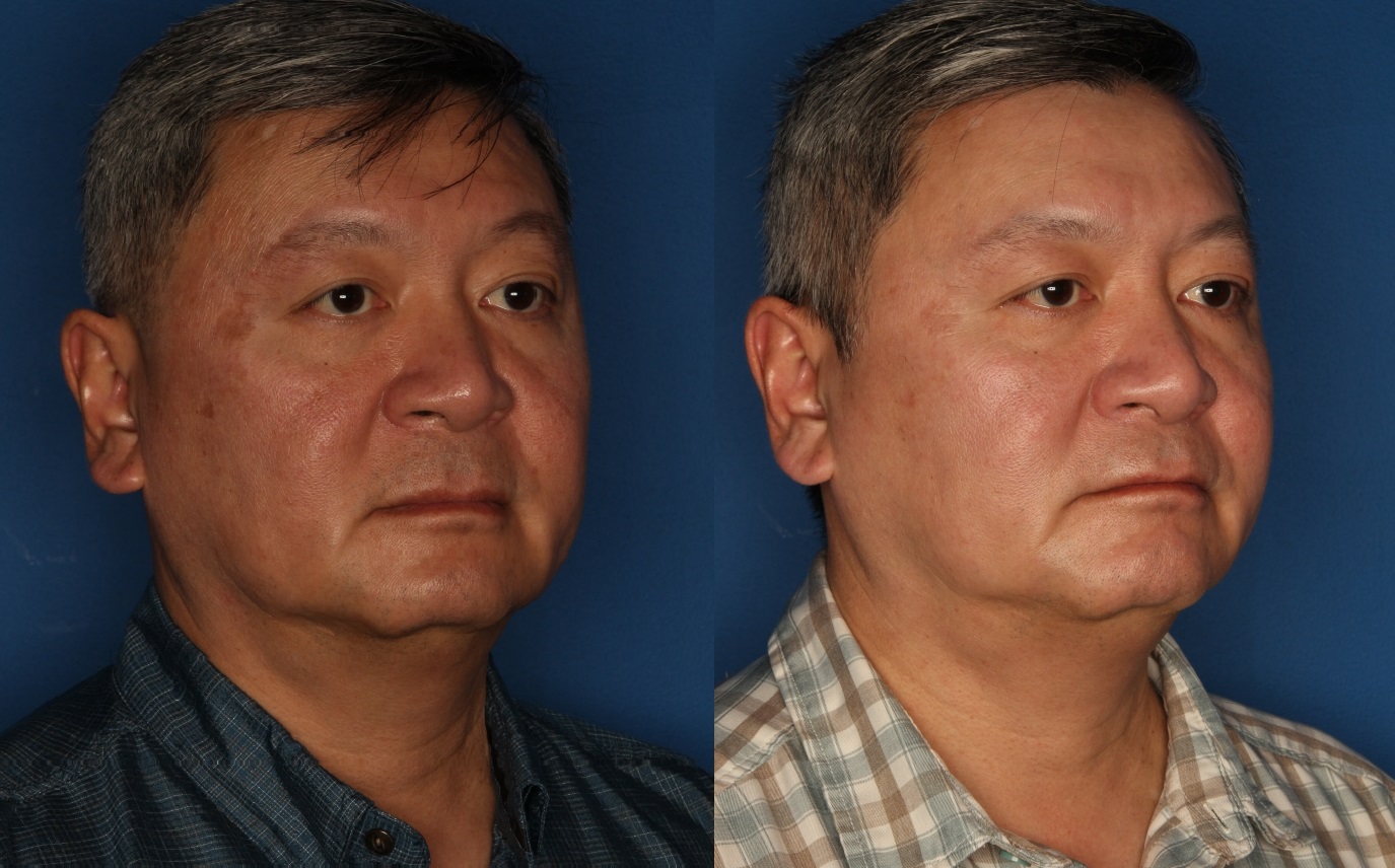 PiQo4™ Laser Before & After Gallery - Patient 146666153 - Image 1