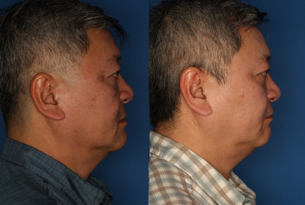 PiQo4 Laser Before & After Gallery - Patient 146666153 - Image 2