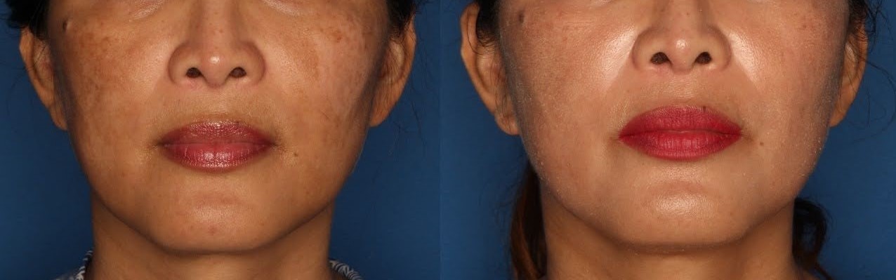 Melasma Gallery Before & After Gallery - Patient 146804101 - Image 1