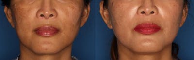 Melasma Before & After Gallery - Patient 146804101 - Image 1