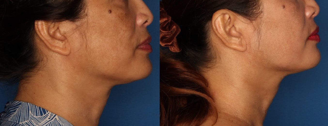 Melasma Before & After Gallery - Patient 146804101 - Image 2