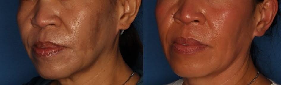 Melasma Before & After Gallery - Patient 146804102 - Image 1