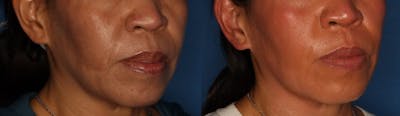 Melasma Gallery Before & After Gallery - Patient 146804102 - Image 2