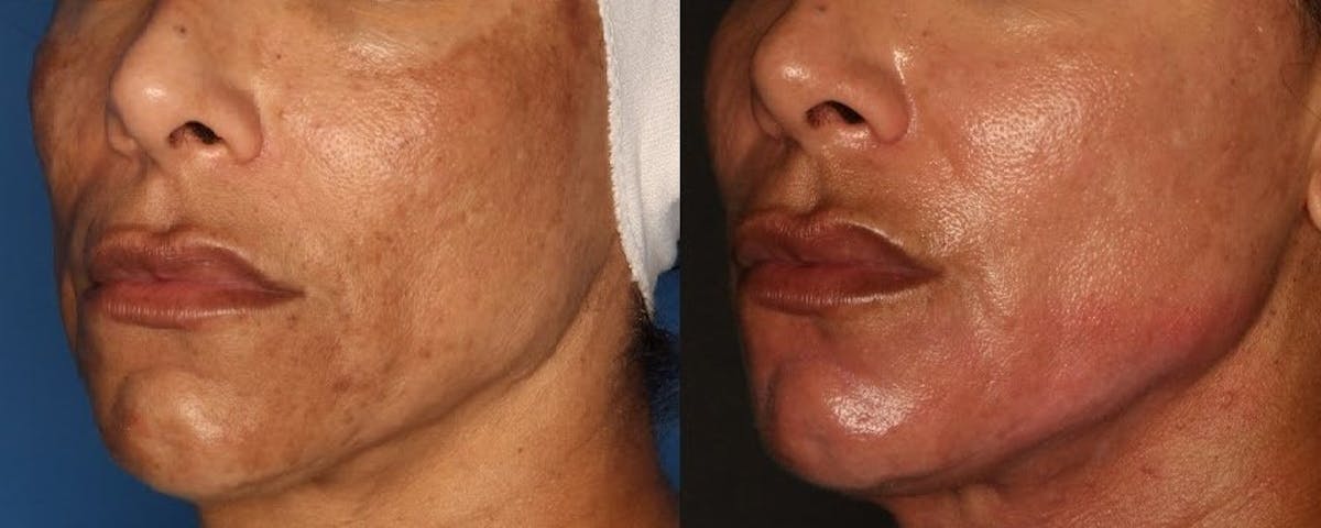 Melasma Gallery Before & After Gallery - Patient 146804103 - Image 1