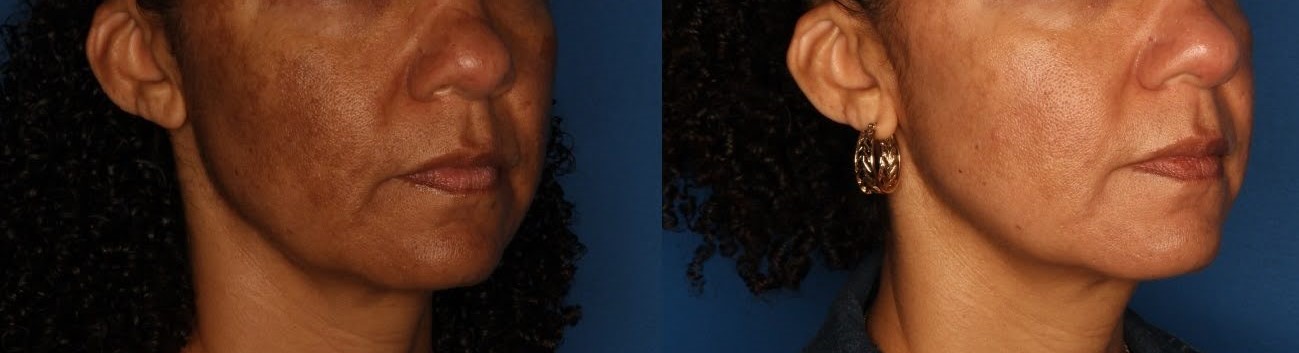 Melasma Before & After Gallery - Patient 146804104 - Image 1