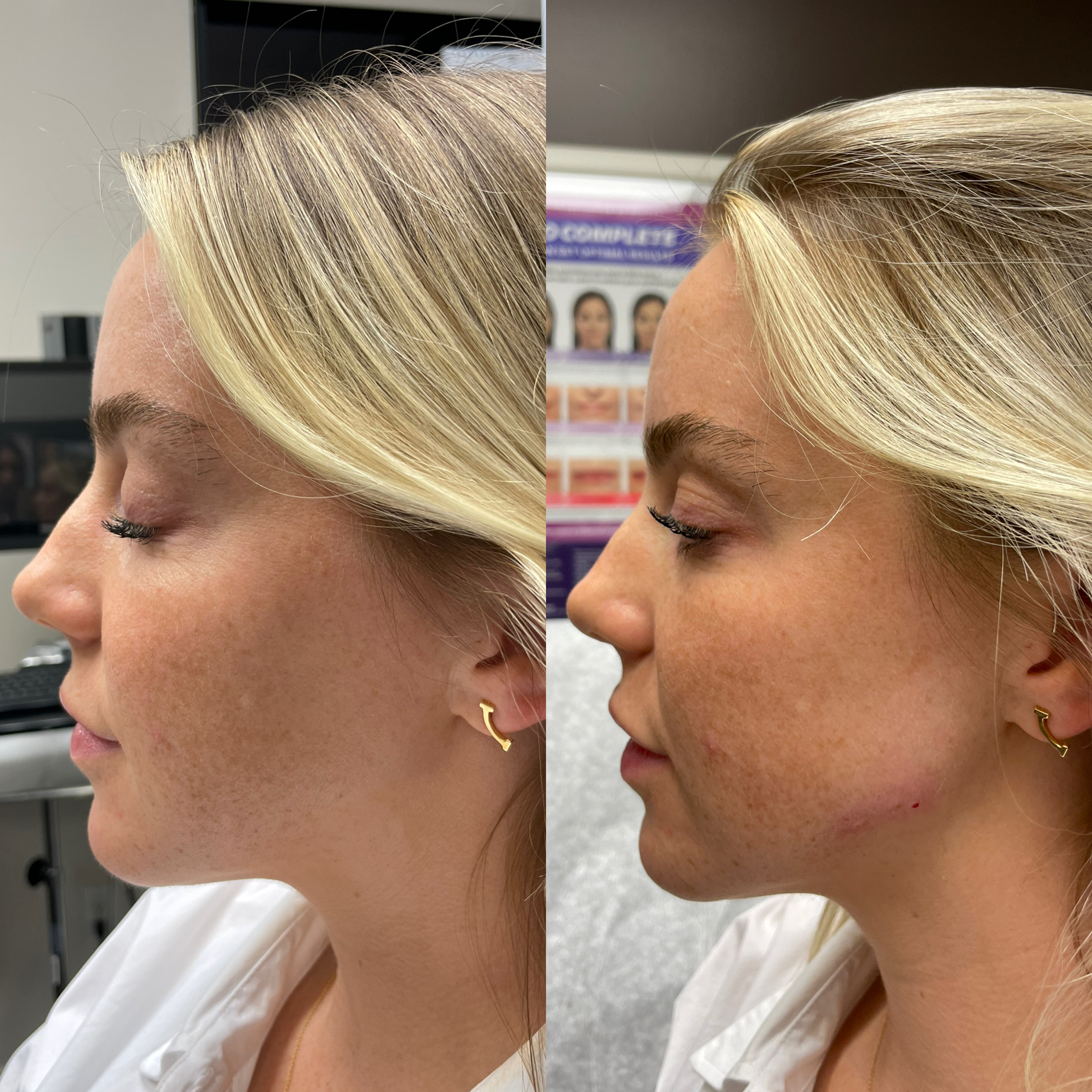 Jawline Augmentation Before & After Gallery - Patient 146804123 - Image 1
