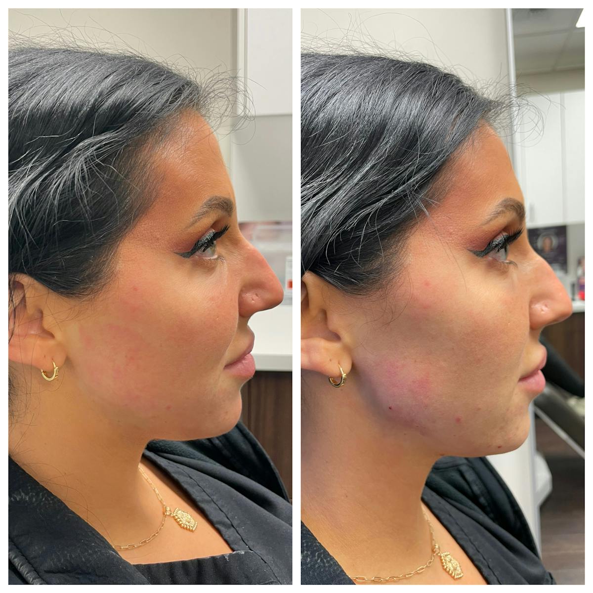 Jawline Augmentation Gallery Before & After Gallery - Patient 146804124 - Image 1