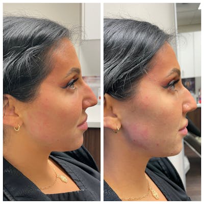 Jawline Augmentation Gallery Before & After Gallery - Patient 146804124 - Image 1