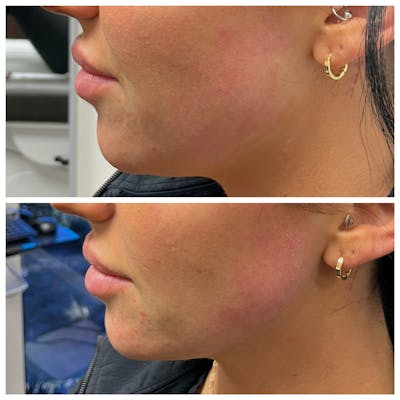 Jawline Augmentation Before & After Gallery - Patient 146804125 - Image 1