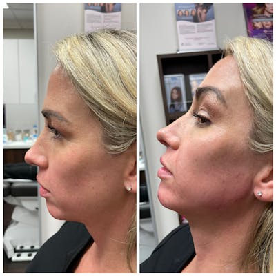 Jawline Augmentation Before & After Gallery - Patient 146804126 - Image 1