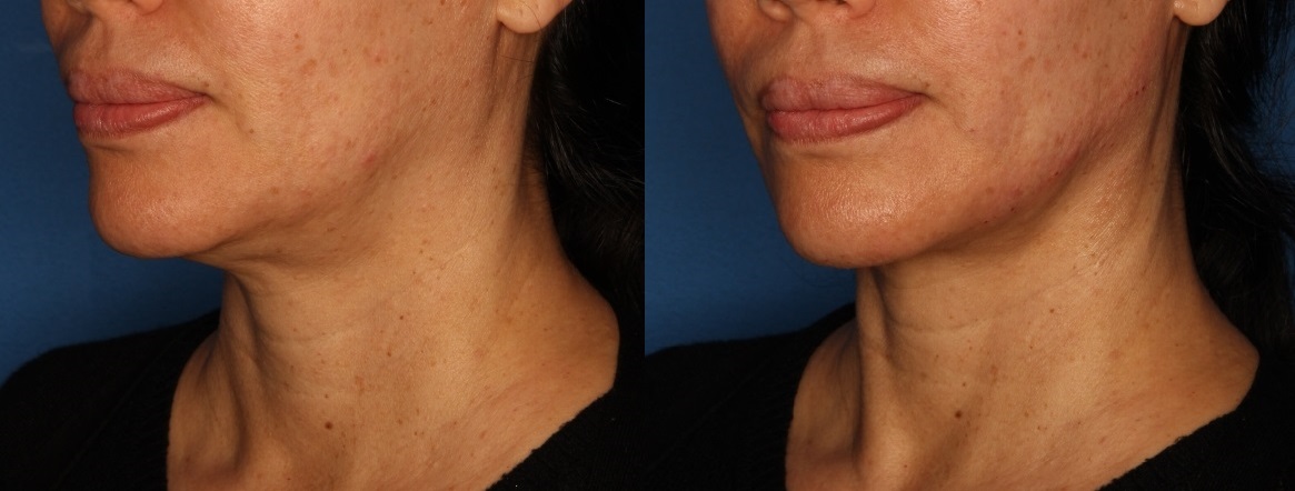 Jawline Augmentation Before & After Gallery - Patient 147064987 - Image 2