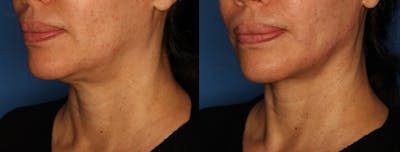 Jawline Augmentation Gallery Before & After Gallery - Patient 147064987 - Image 2