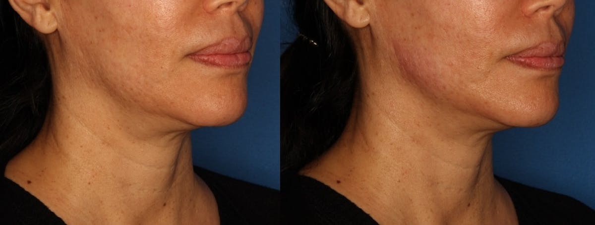 Jawline Augmentation Before & After Gallery - Patient 147064987 - Image 1