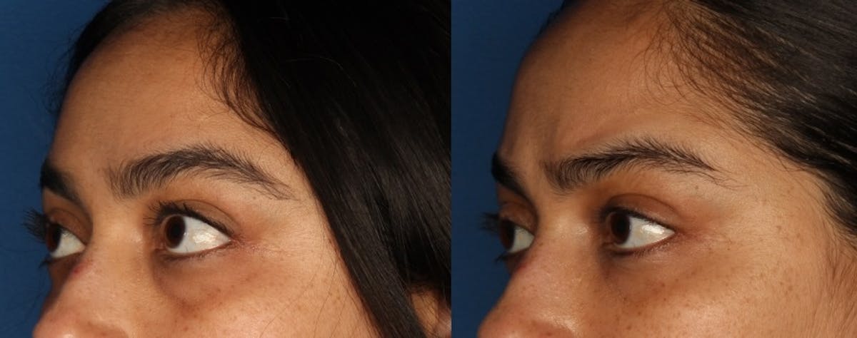 Tear Trough Augmentation Gallery Before & After Gallery - Patient 147122388 - Image 1