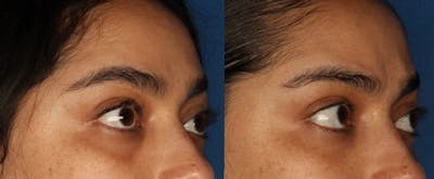 Tear Trough Augmentation Gallery Before & After Gallery - Patient 147122388 - Image 2