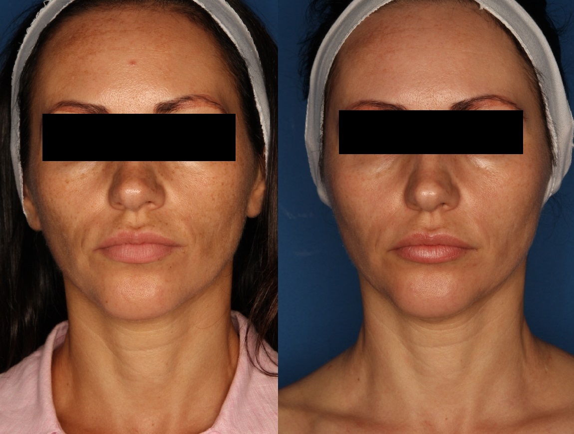 PiQo4 Laser Before & After Gallery - Patient 147123193 - Image 1