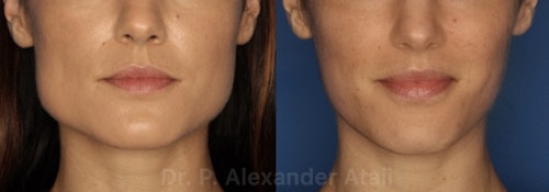 Before and After Botox for TMJ